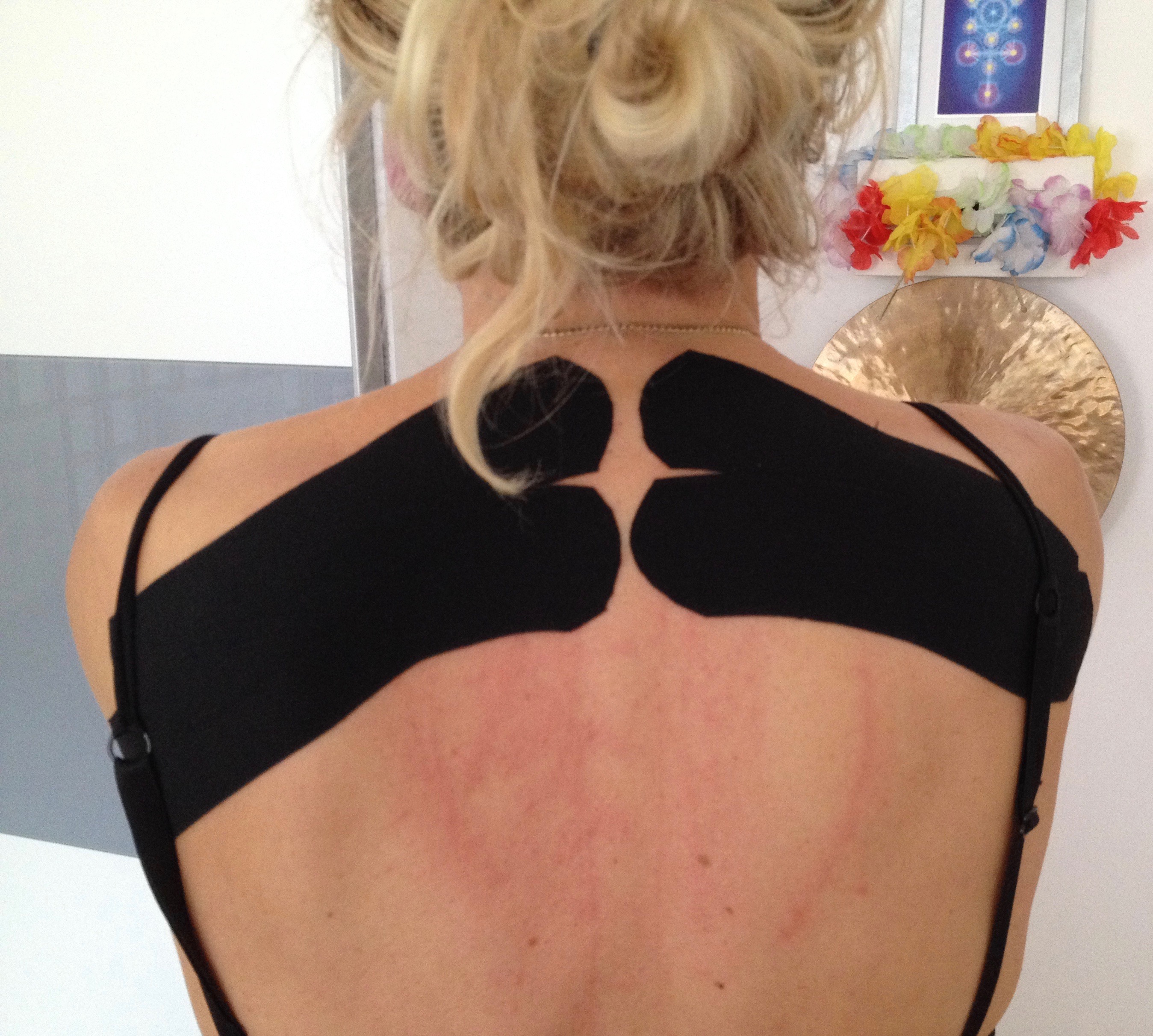 Kinesiotape des Schulterblattes